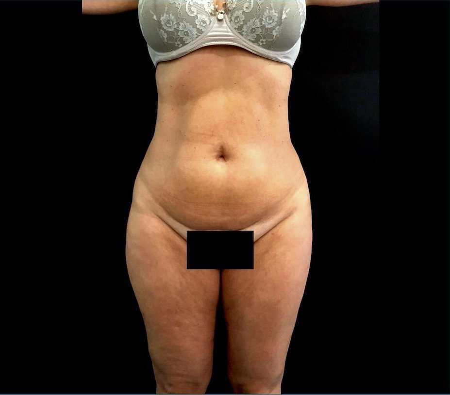 aaclinic-antes-despues-vaser-lipo-3