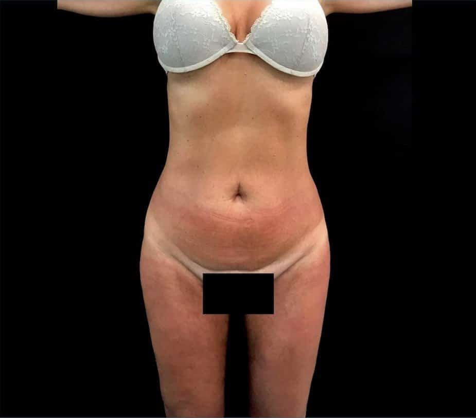 aaclinic-antes-despues-vaser-lipo-4