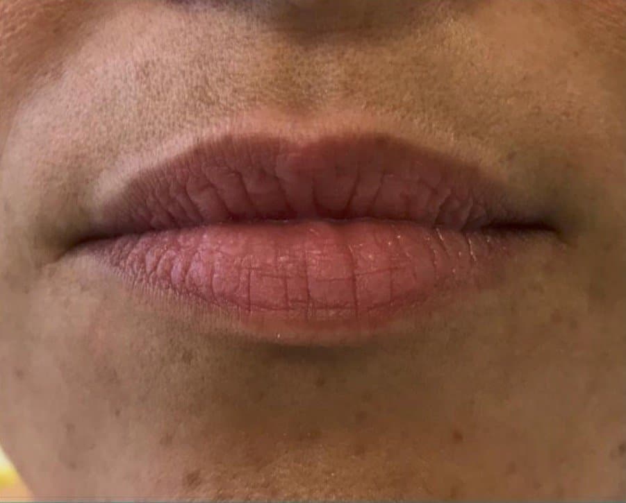 aaclinic-antes-y-despues-labios-1