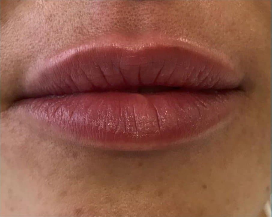 aaclinic-antes-y-despues-labios-2