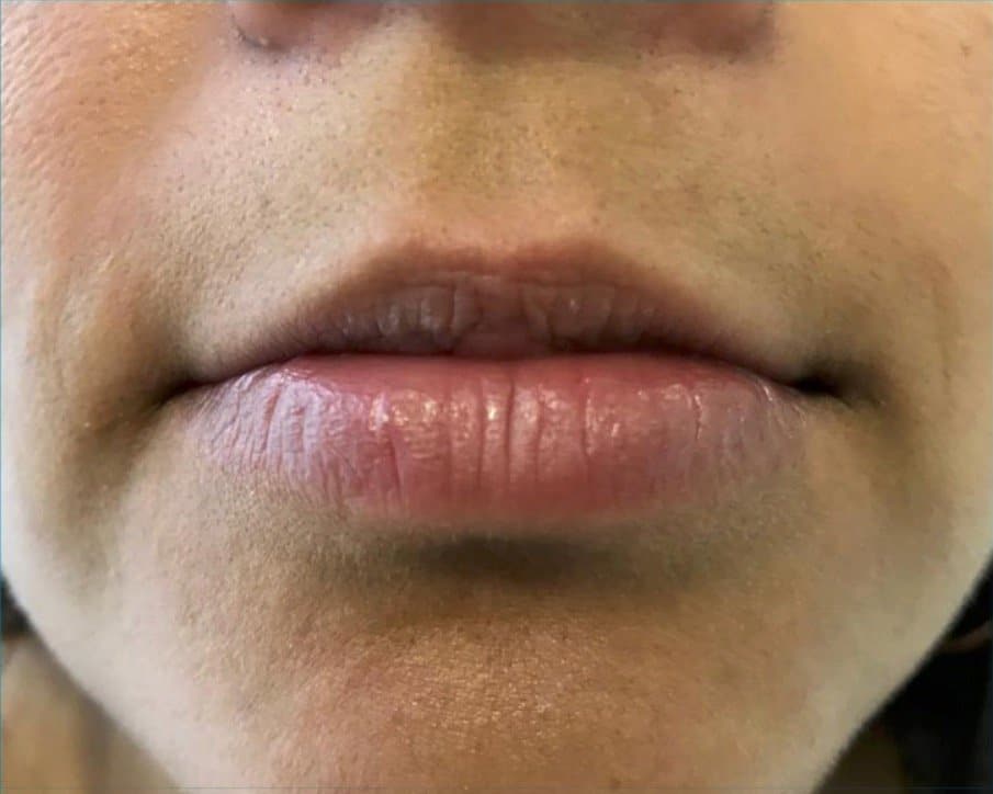 aaclinic-antes-y-despues-labios-3