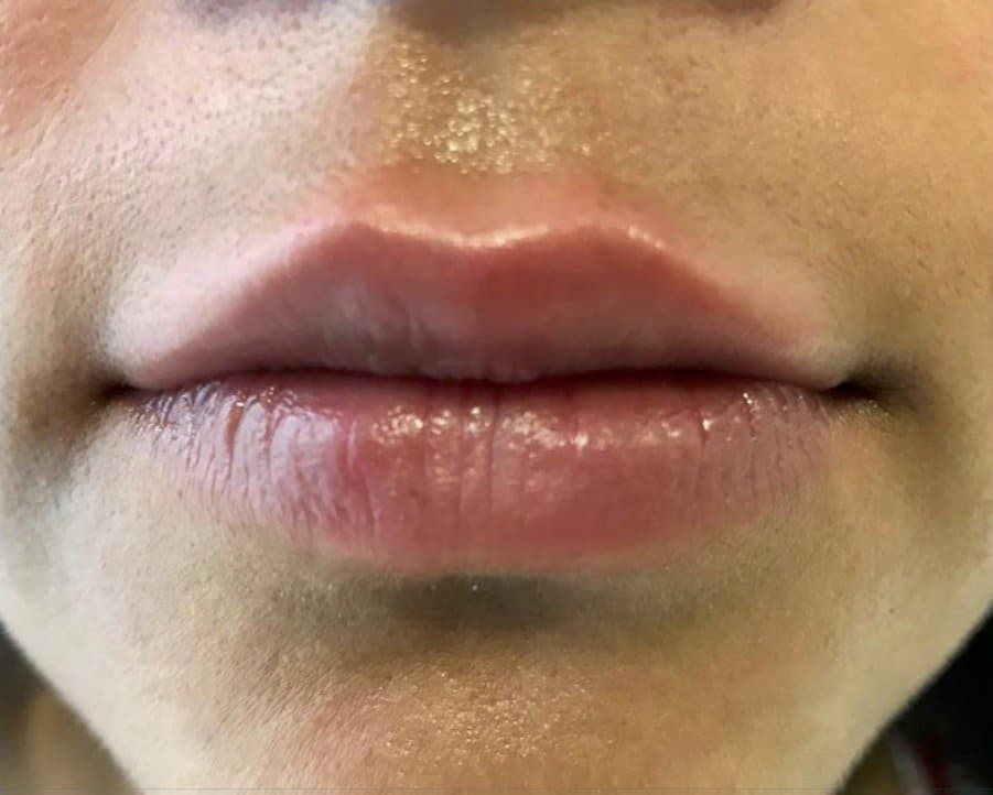 aaclinic-antes-y-despues-labios-4