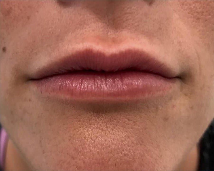 aaclinic-antes-y-despues-labios-5