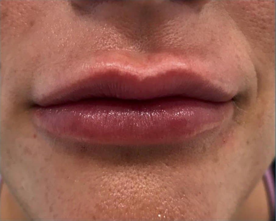 aaclinic-antes-y-despues-labios-6