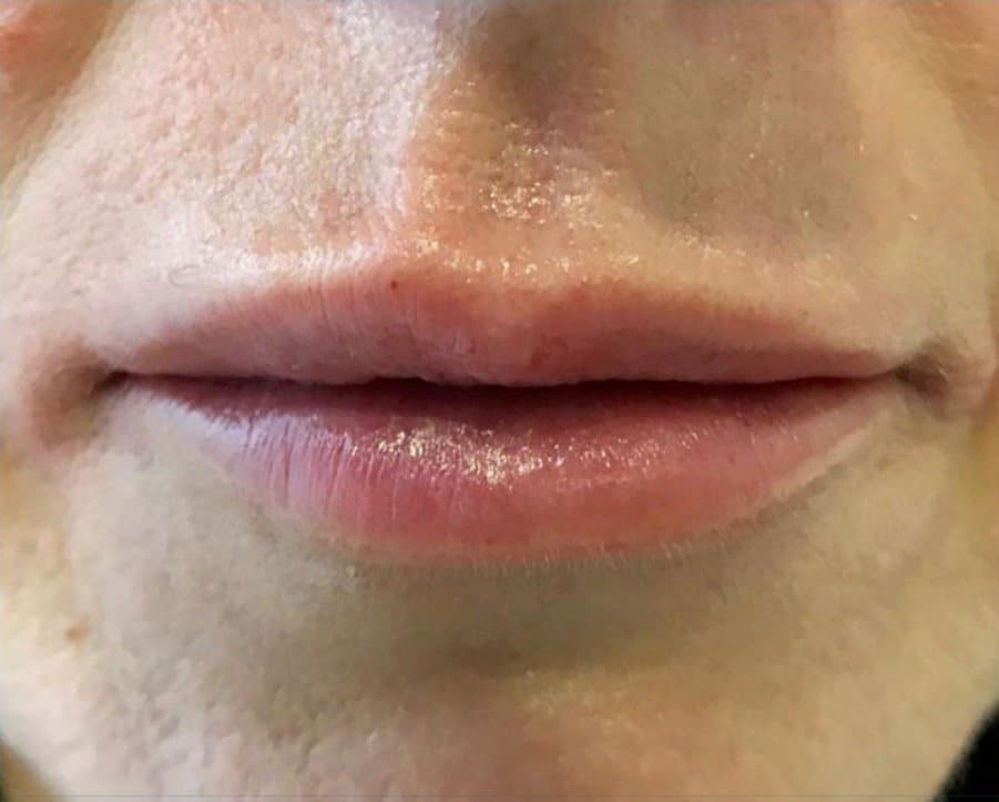 aaclinic-antes-y-despues-labios-7