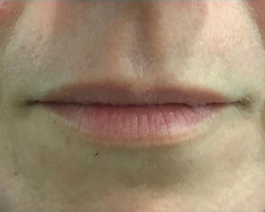 aaclinic-antes-y-despues-labios-8
