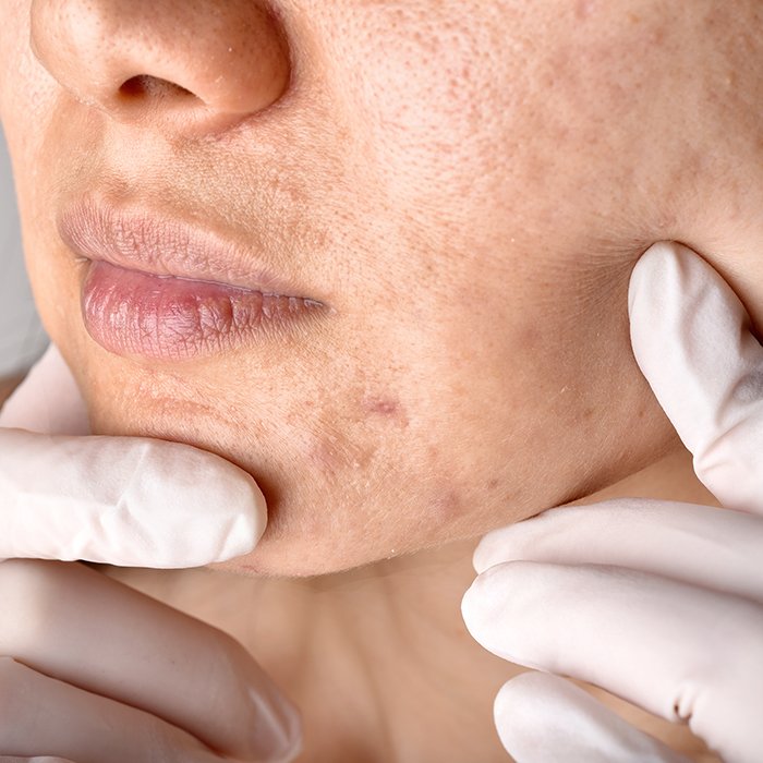 aaclinic-cicatrices-post-acne