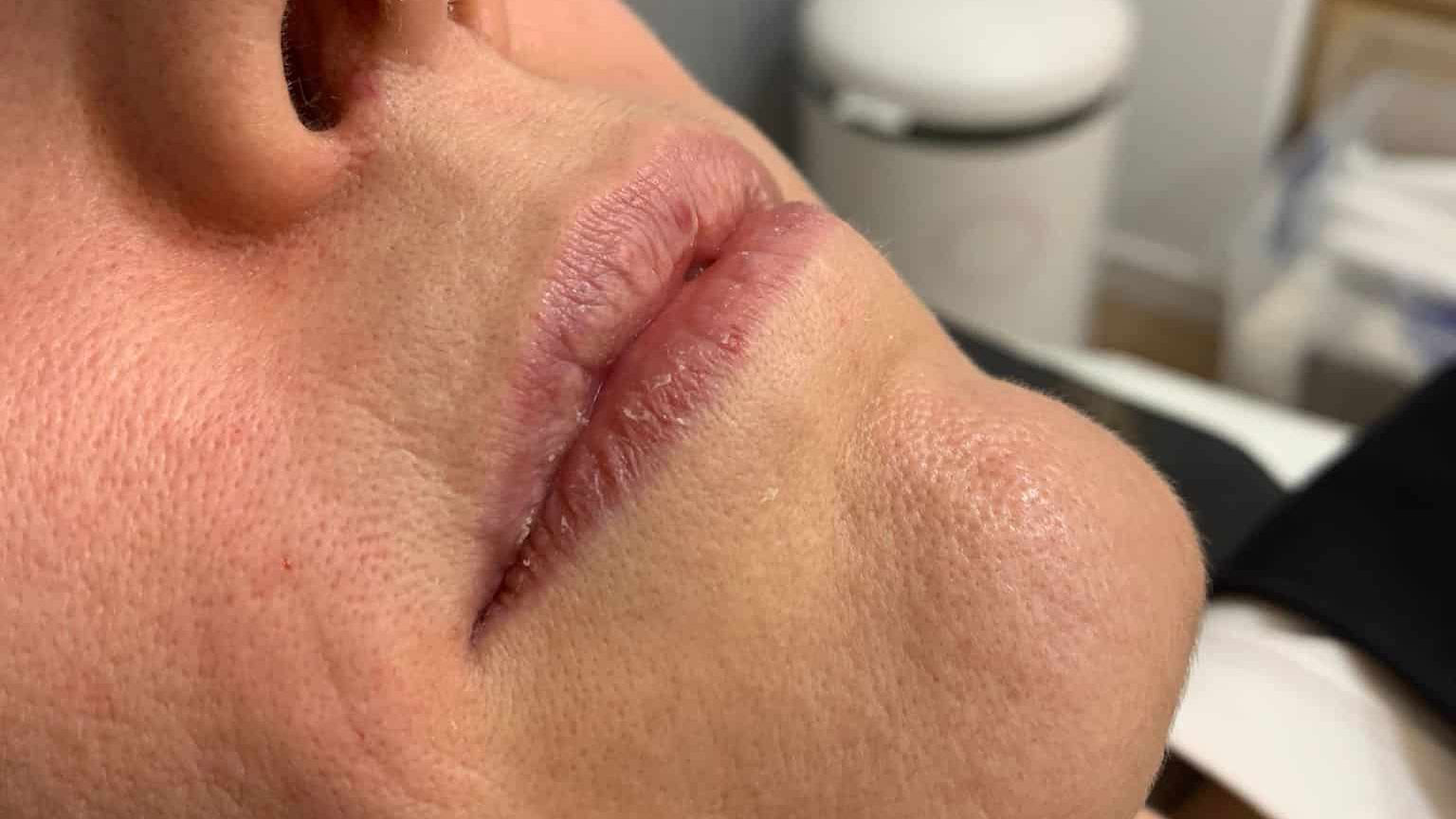 aaclinic-labios-acido-hialuronico-antes-y-despues-2025-1