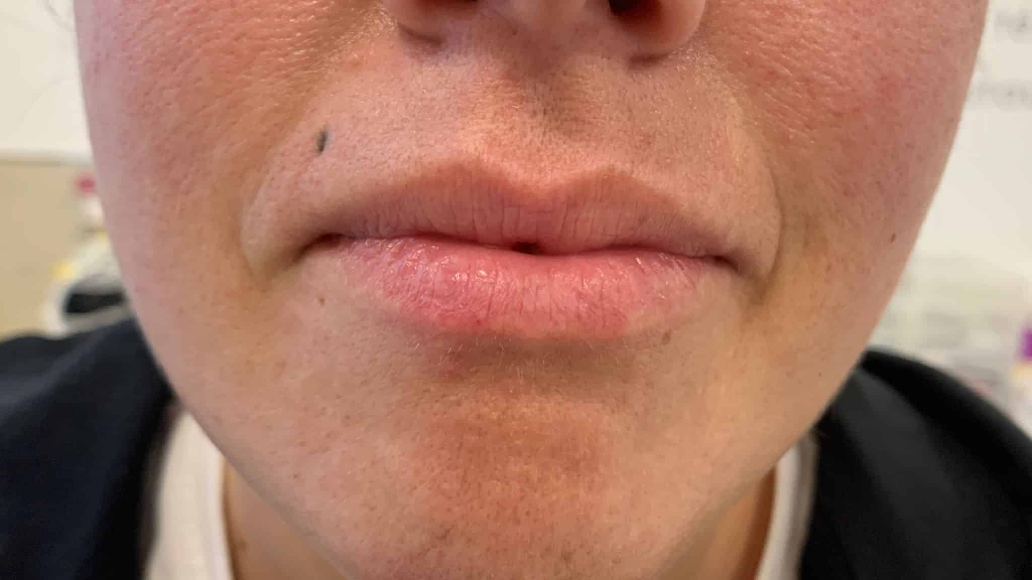 aaclinic-labios-acido-hialuronico-antes-y-despues-2025-10