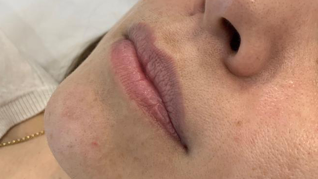 aaclinic-labios-acido-hialuronico-antes-y-despues-2025-11