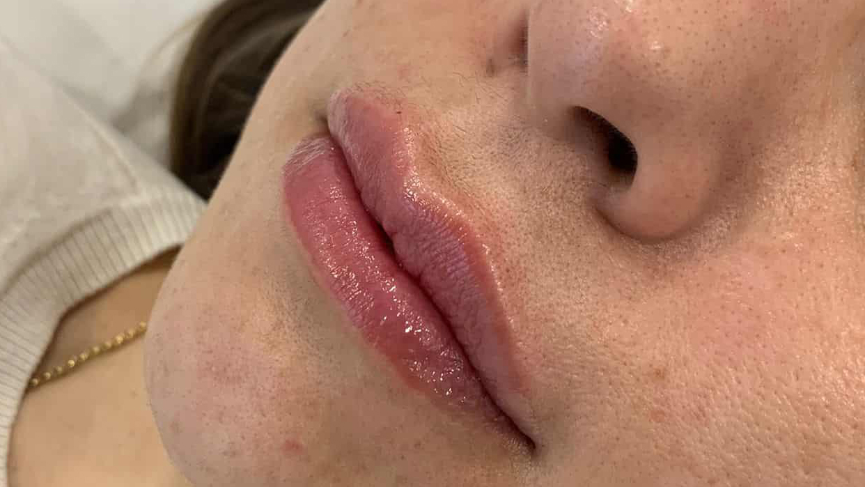 aaclinic-labios-acido-hialuronico-antes-y-despues-2025-12