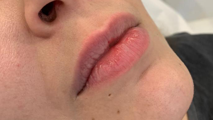 aaclinic-labios-acido-hialuronico-antes-y-despues-2025-13