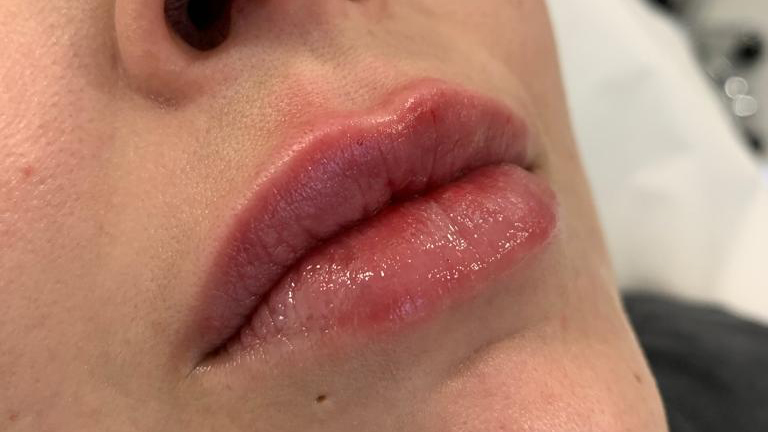 aaclinic-labios-acido-hialuronico-antes-y-despues-2025-14