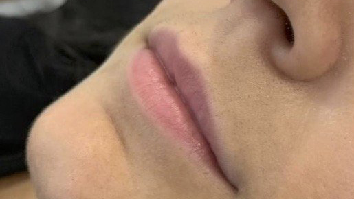 aaclinic-labios-acido-hialuronico-antes-y-despues-2025-15