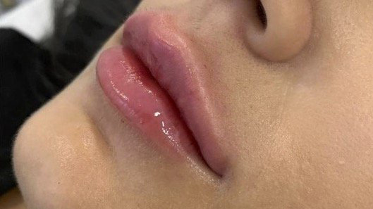 aaclinic-labios-acido-hialuronico-antes-y-despues-2025-16