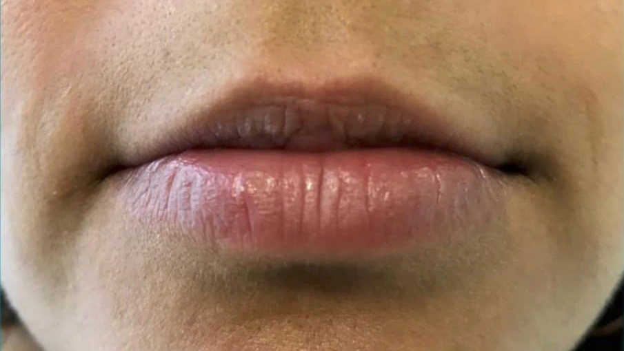 aaclinic-labios-acido-hialuronico-antes-y-despues-2025-17