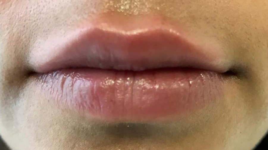 aaclinic-labios-acido-hialuronico-antes-y-despues-2025-18