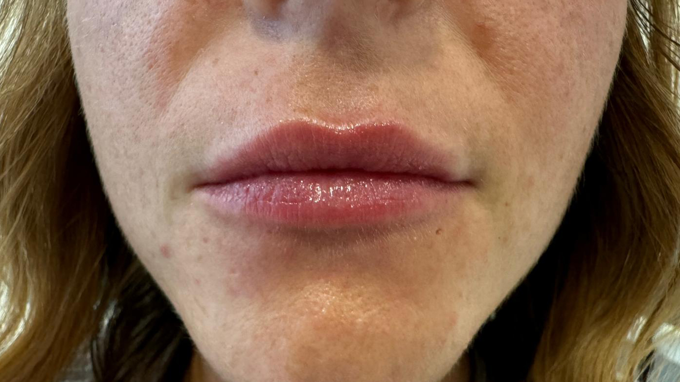 aaclinic-labios-acido-hialuronico-antes-y-despues-2025-19
