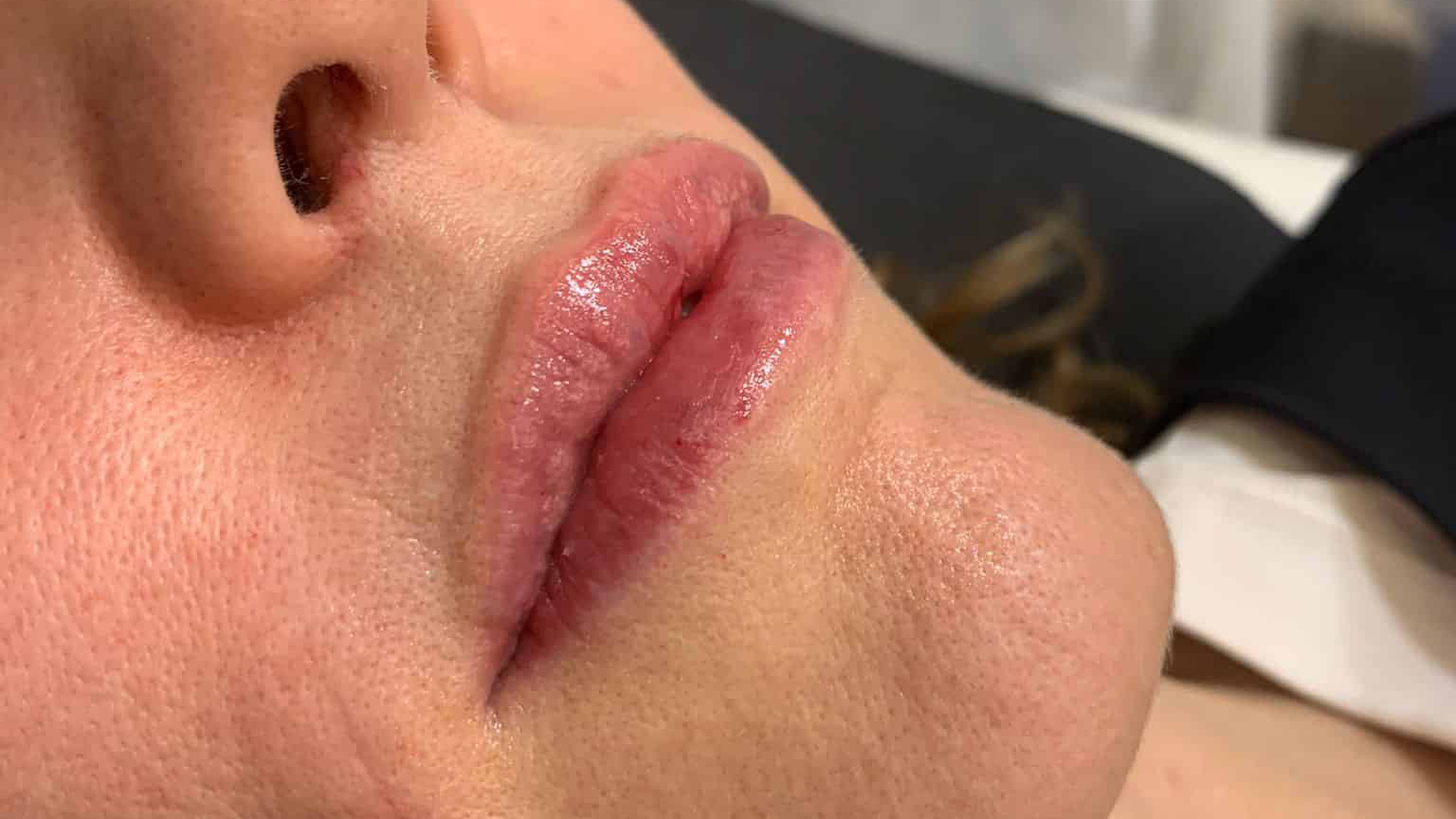 aaclinic-labios-acido-hialuronico-antes-y-despues-2025-2