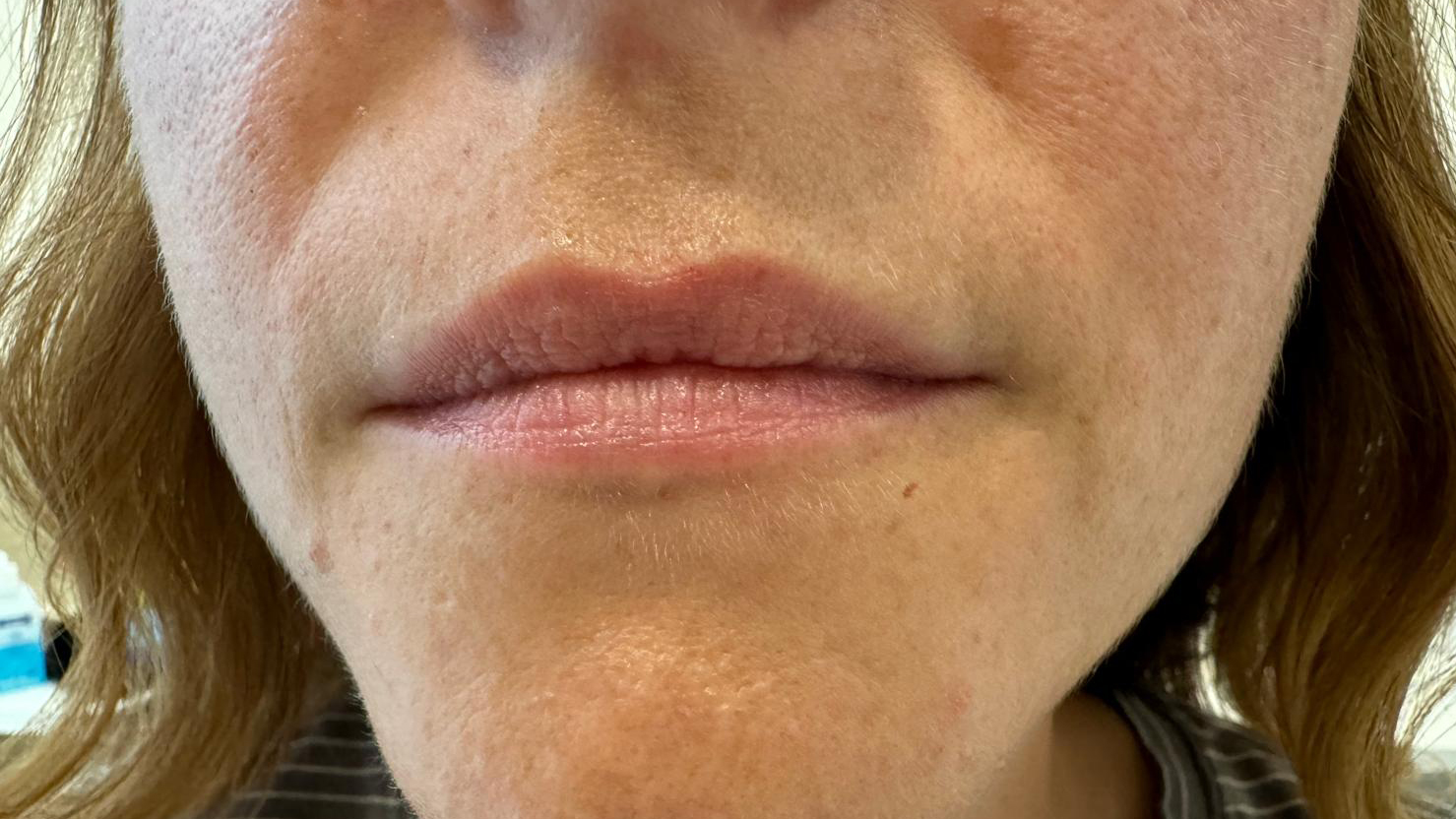 aaclinic-labios-acido-hialuronico-antes-y-despues-2025-20