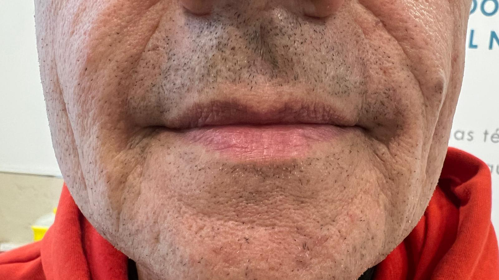 aaclinic-labios-acido-hialuronico-antes-y-despues-2025-21