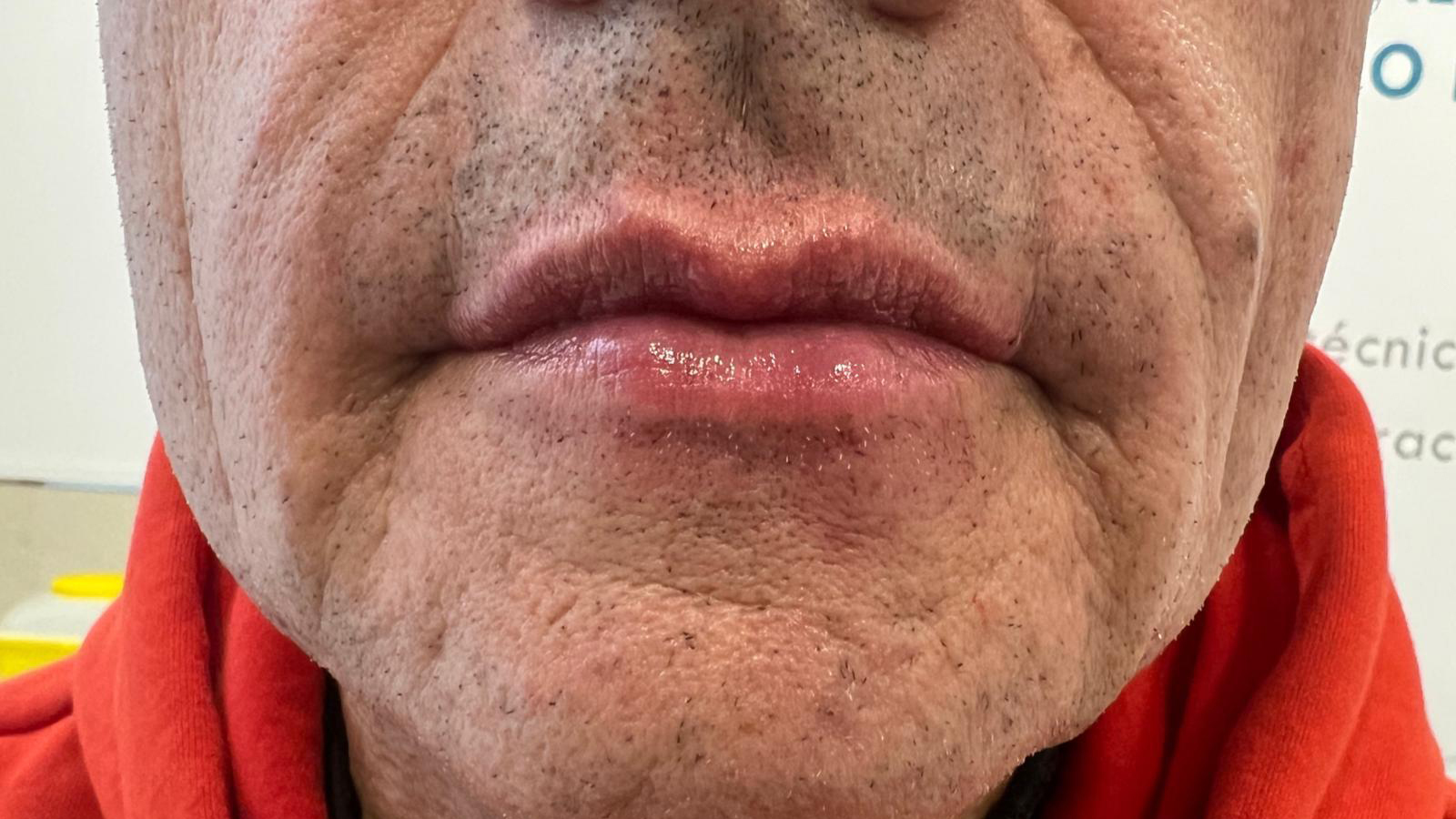 aaclinic-labios-acido-hialuronico-antes-y-despues-2025-22