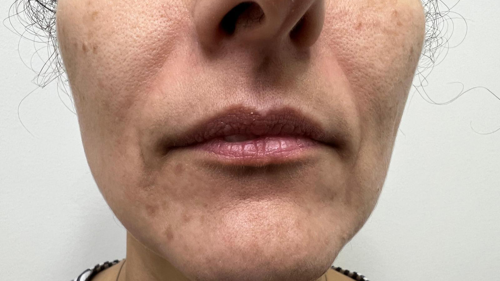 aaclinic-labios-acido-hialuronico-antes-y-despues-2025-23