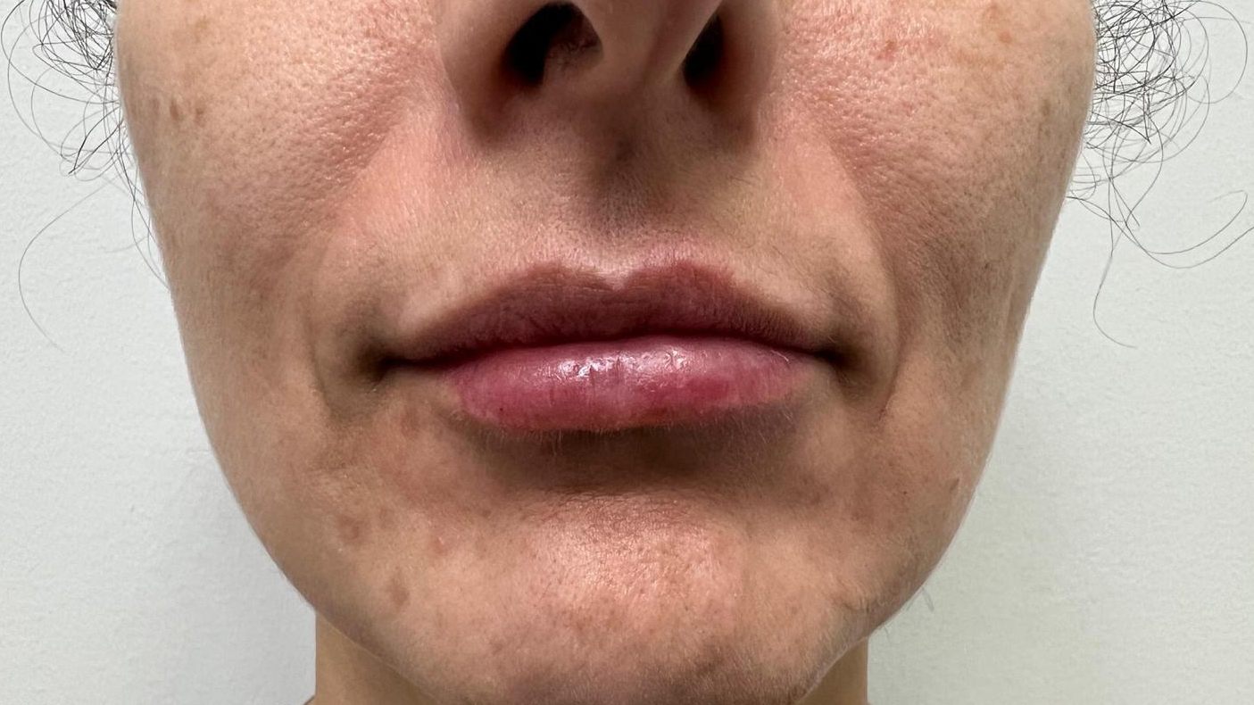 aaclinic-labios-acido-hialuronico-antes-y-despues-2025-24