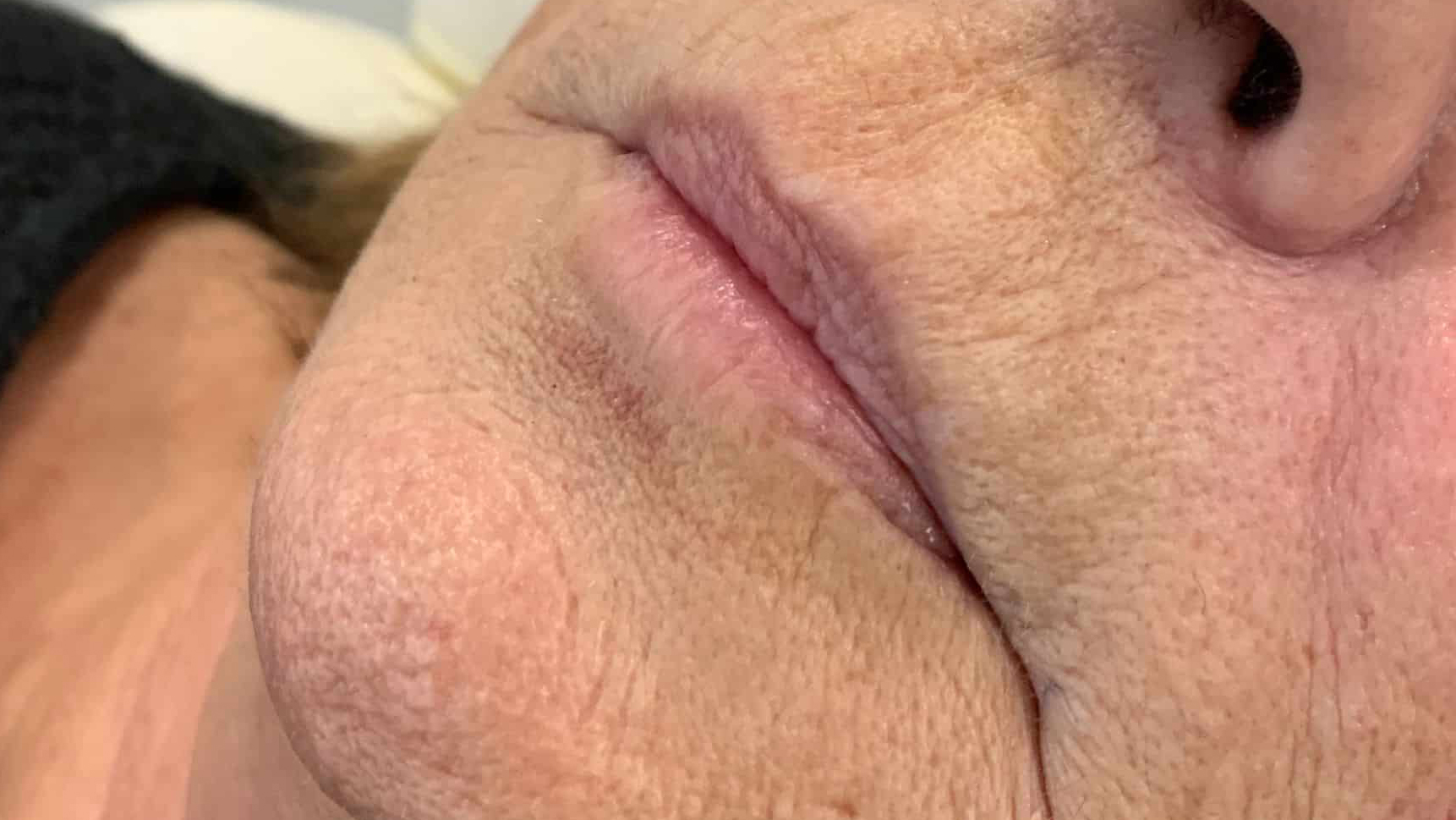 aaclinic-labios-acido-hialuronico-antes-y-despues-2025-3