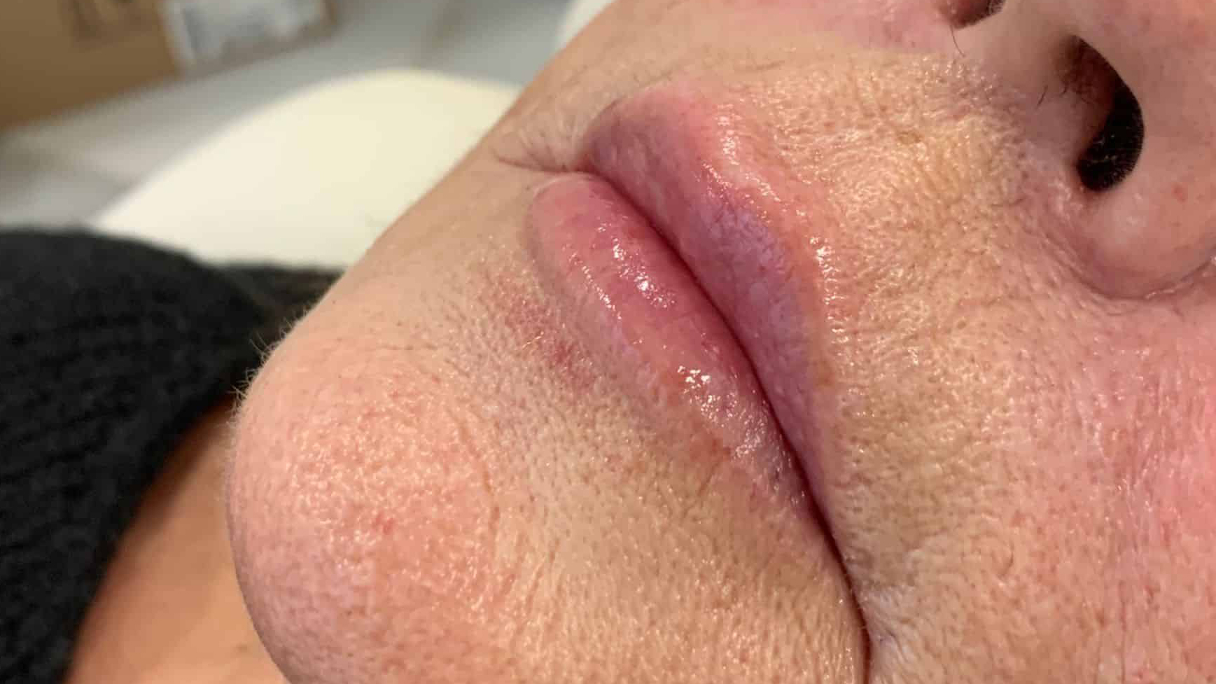 aaclinic-labios-acido-hialuronico-antes-y-despues-2025-4