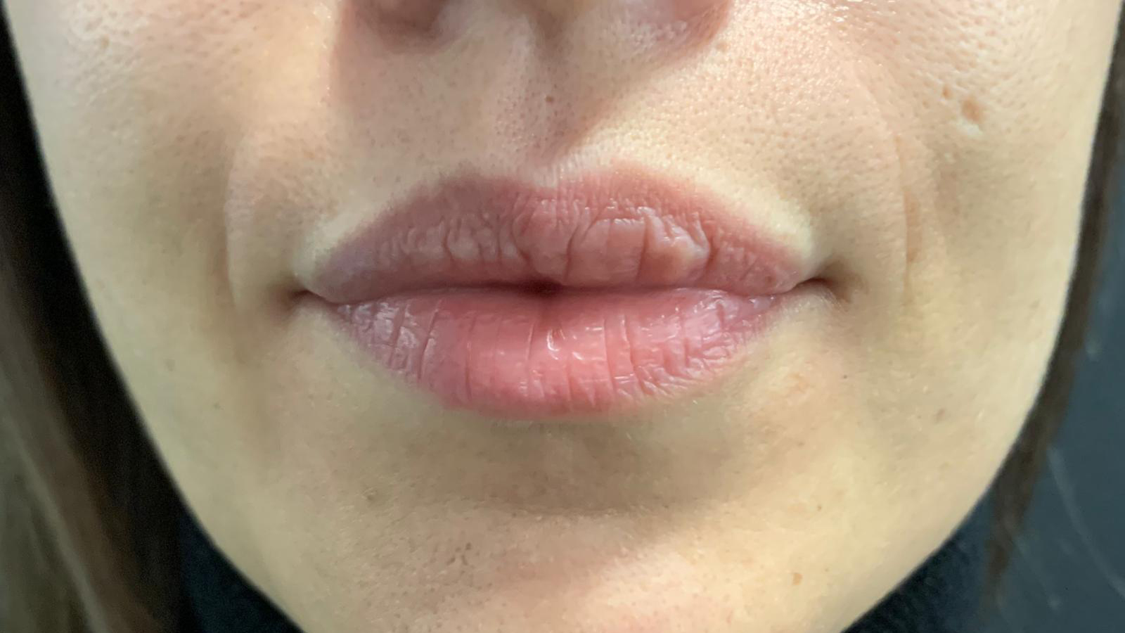 aaclinic-labios-acido-hialuronico-antes-y-despues-2025-5