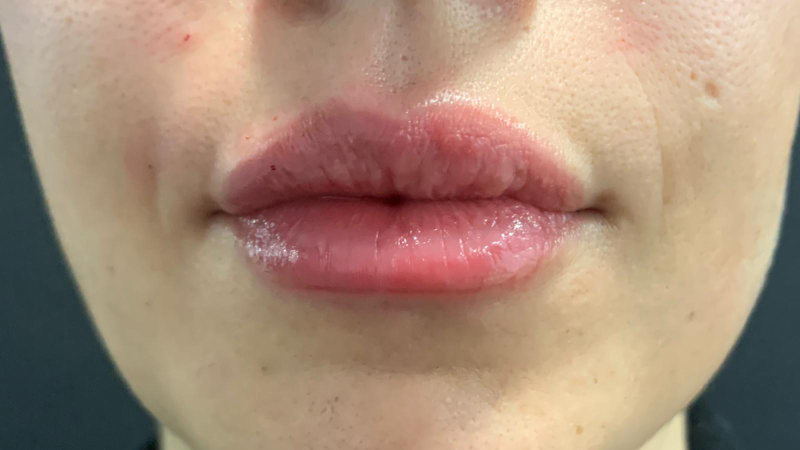 aaclinic-labios-acido-hialuronico-antes-y-despues-2025-6