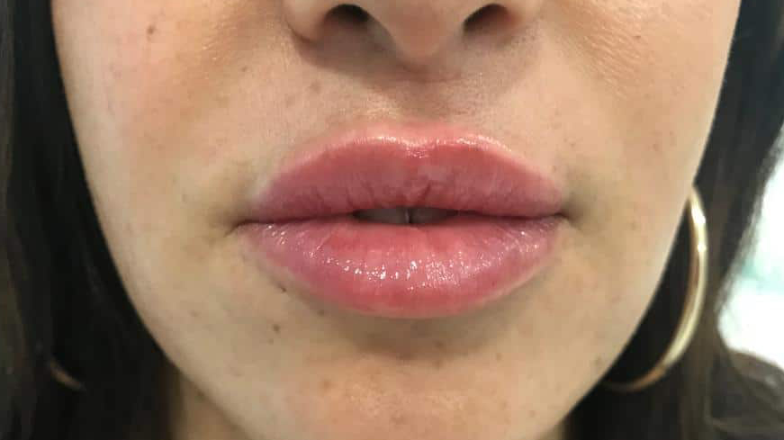 aaclinic-labios-acido-hialuronico-antes-y-despues-2025-7