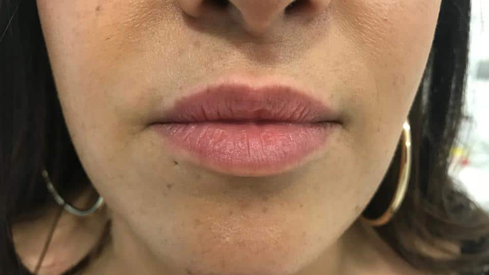 aaclinic-labios-acido-hialuronico-antes-y-despues-2025-8