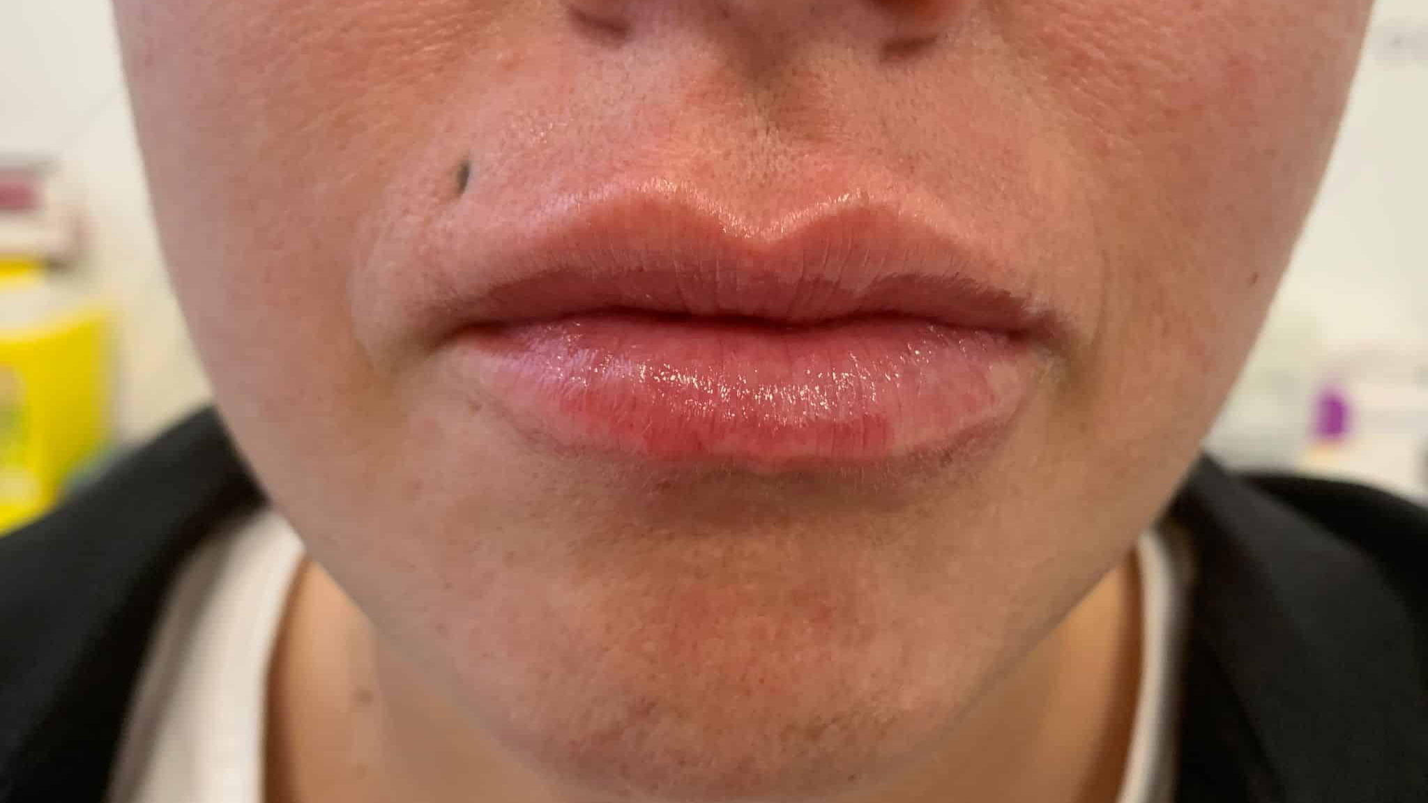 aaclinic-labios-acido-hialuronico-antes-y-despues-2025-9