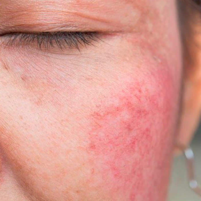 aaclinic-rosacea