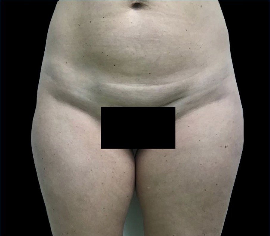 antes y despues vaser lipo