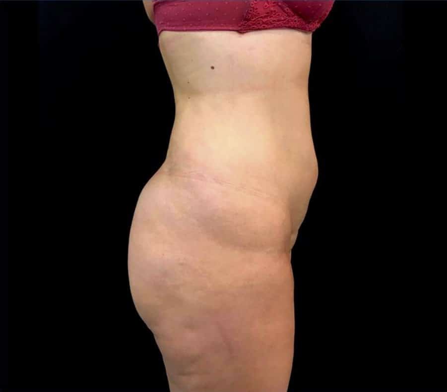 antes y despues vaser lipo