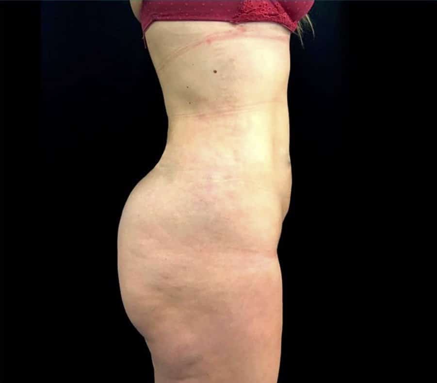 antes y despues vaser lipo