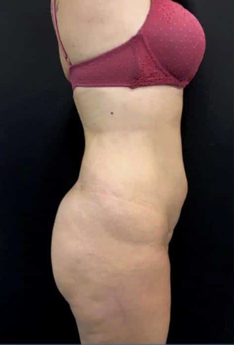 antes-y-despues-lipoelite-1