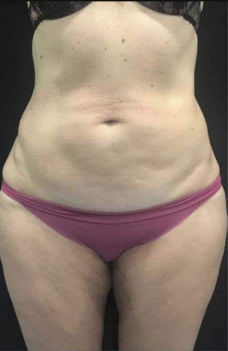 antes-y-despues-lipoelite-2