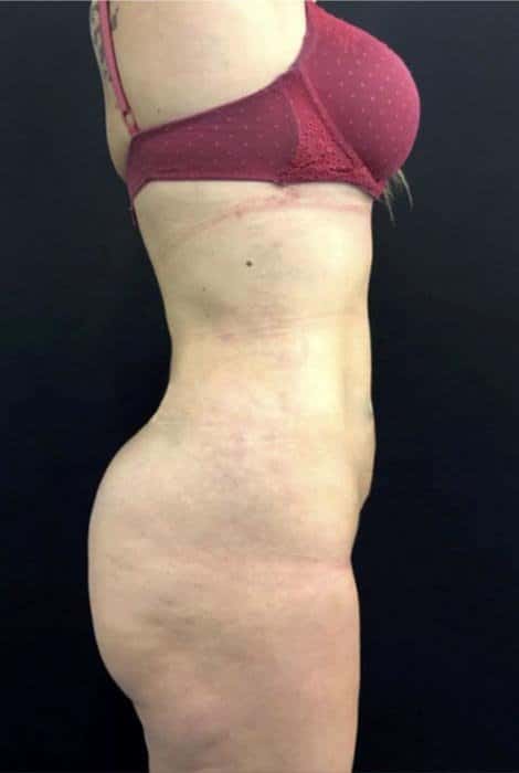 antes-y-despues-lipoelite-3