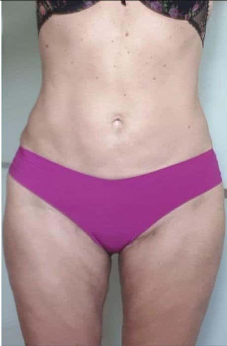 antes-y-despues-lipoelite-4