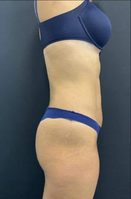 antes-y-despues-lipoelite-5