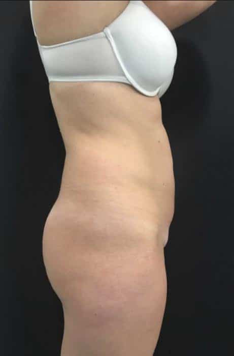 antes-y-despues-lipoelite-6