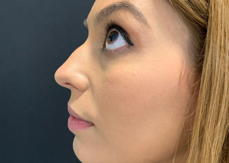 antes y después de rinomodelación con ácido hialurónico