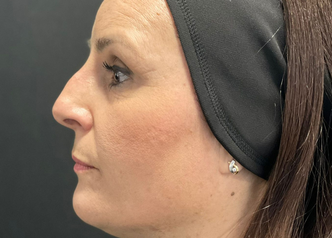 antes y después de rinomodelación con ácido hialurónico