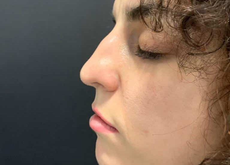 antes y después de rinomodelación con ácido hialurónico