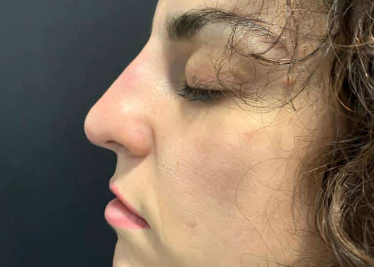 antes y después de rinomodelación con ácido hialurónico