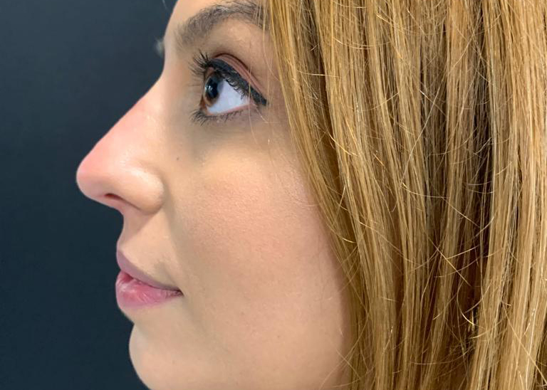 antes y después de rinomodelación con ácido hialurónico